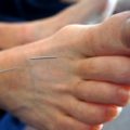Does Acupuncture Work?