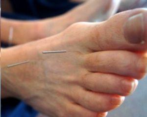 Does Acupuncture Work? 
